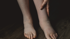 Swollen legs affected by lymphedema